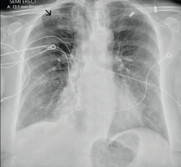 Porous Diaphragm Syndrome Spontaneous Pneumothorax After Diagnostic