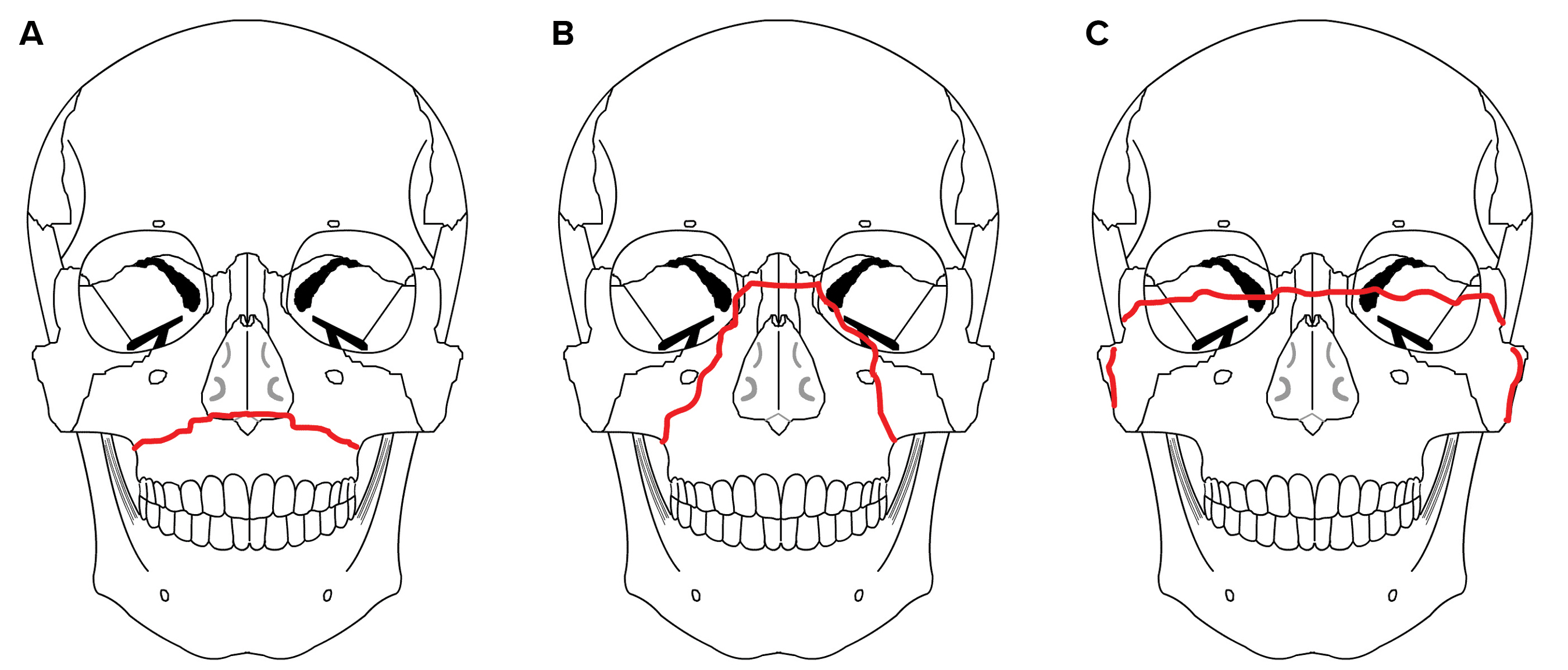 Lefort Injuries Airway Management for Craniofacial Trauma