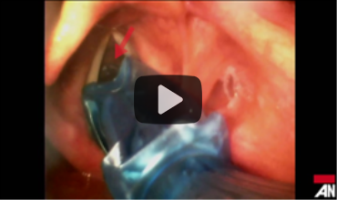 Airway on Demand: Bevel Catch During Hyperangulated VL Intubation