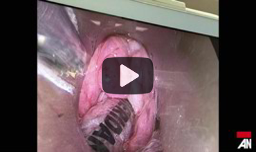 Airway on Demand: Incidental Laryngeal Mass Follow-Up