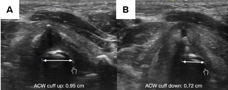 Point-of-Care Ultrasound for Upper Airway Management And Gastric Ultrasound