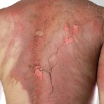 Regional Anesthesia Helps Improve  Acute Pain Outcomes for Burn Patients