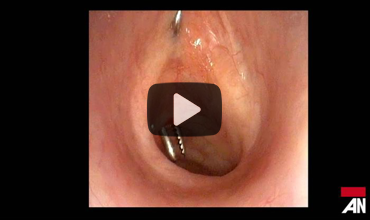 Airway on Demand: Watching a Tracheostomy From Inside the Larynx 